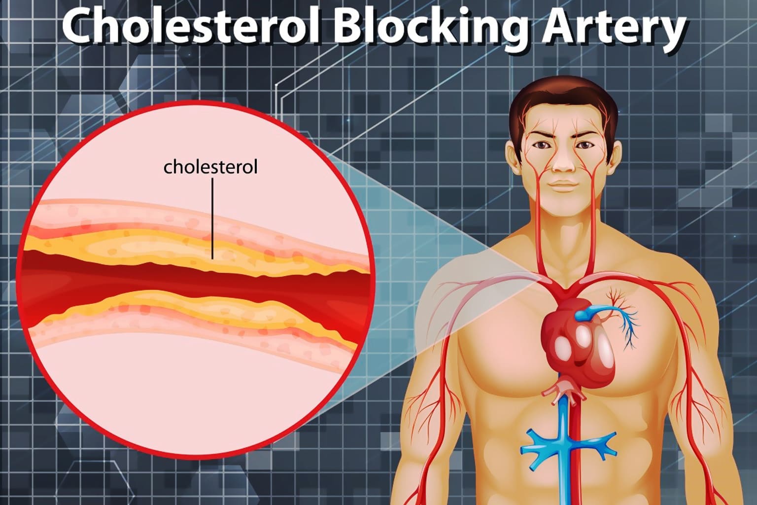 Scientific Research Reveals Scratch Cupping Eliminates Neck Pain and Tingling in Cholesterol Patients