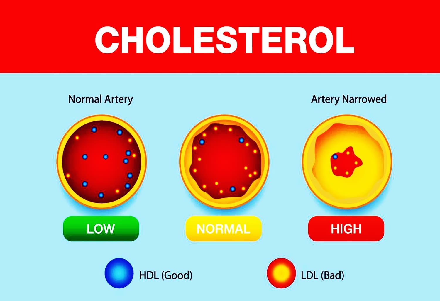 The Effect of Wet Cupping Singapore Therapy on Reducing Cholesterol Levels in Patients with Hypercholesterolemia