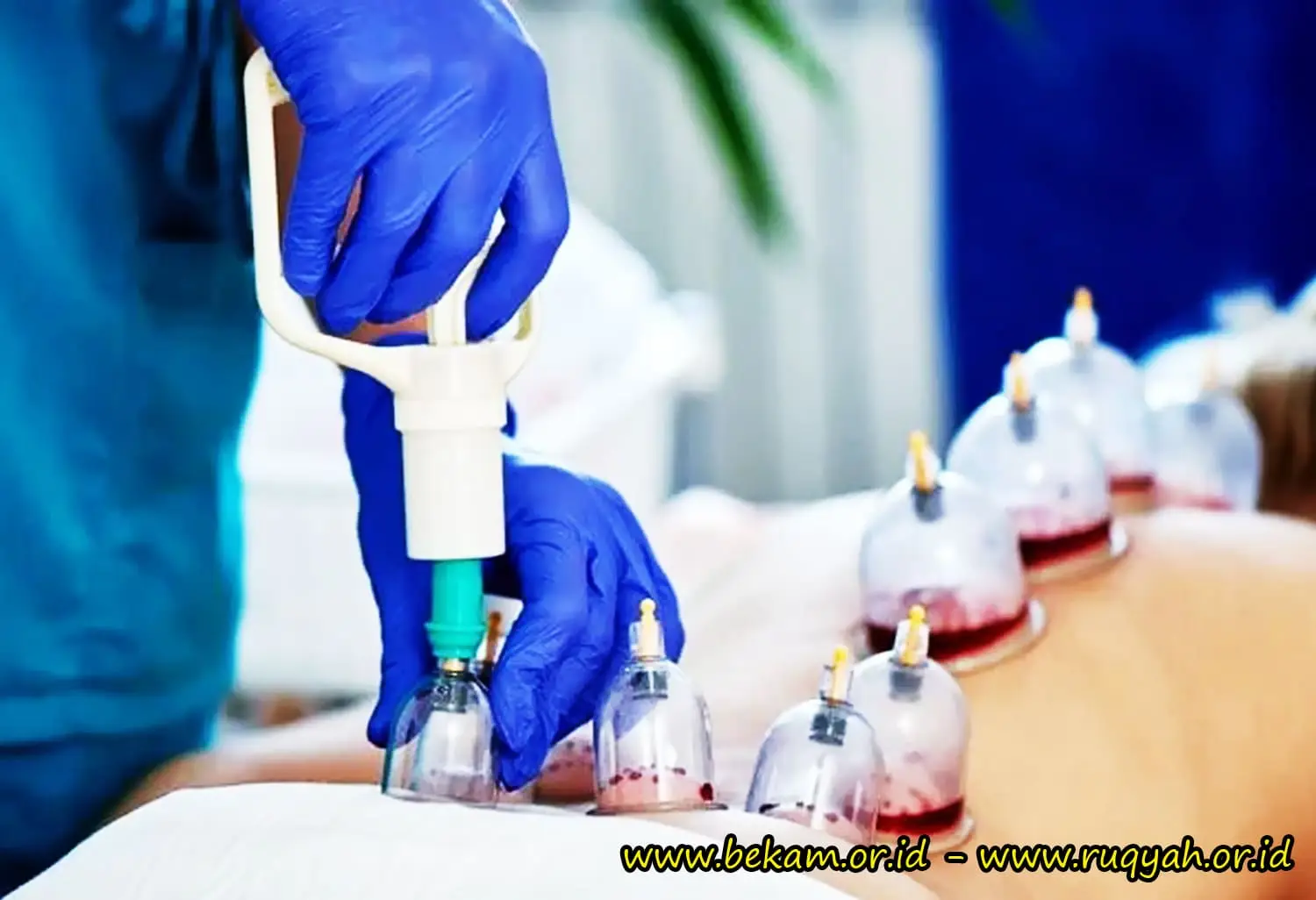 Wet Cupping Therapy Singapore for Chronic Back Pain, An Integrative and Complementary Approach